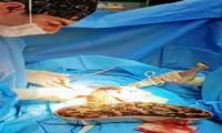 خروج بیش از ۹۰ پک مواد مخدر از شکم بیمار در یک جراحی خطیر در مرکز آموزشی درمانی شهید مدنی کرج